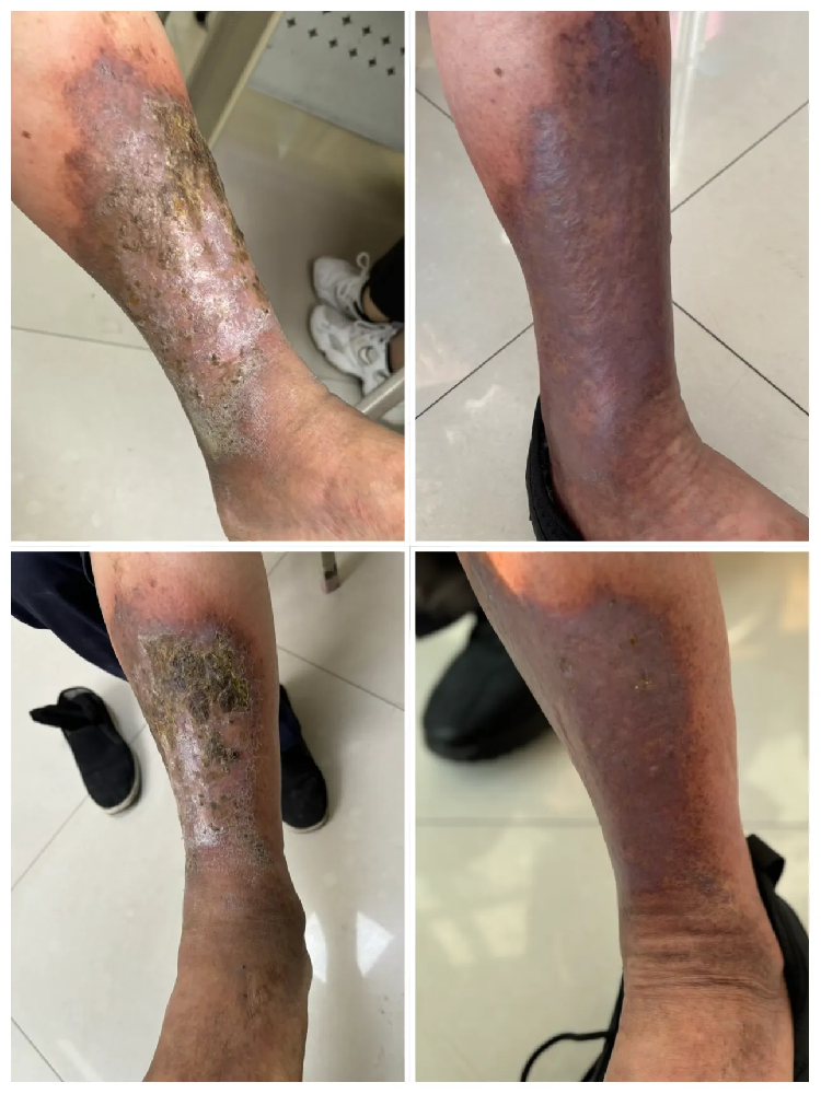【杨陵惠仁医院皮肤科真实案例】瘀积性皮炎患者的治愈之路